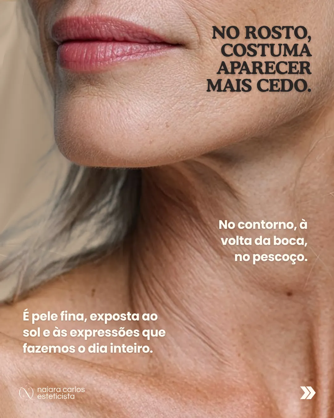 Grande plano do queixo e do pescoço: no rosto a flacidez costuma aparecer mais cedo, no contorno, à volta da boca e no pescoço, porque é pele fina, exposta ao sol e às expressões que fazemos o dia inteiro