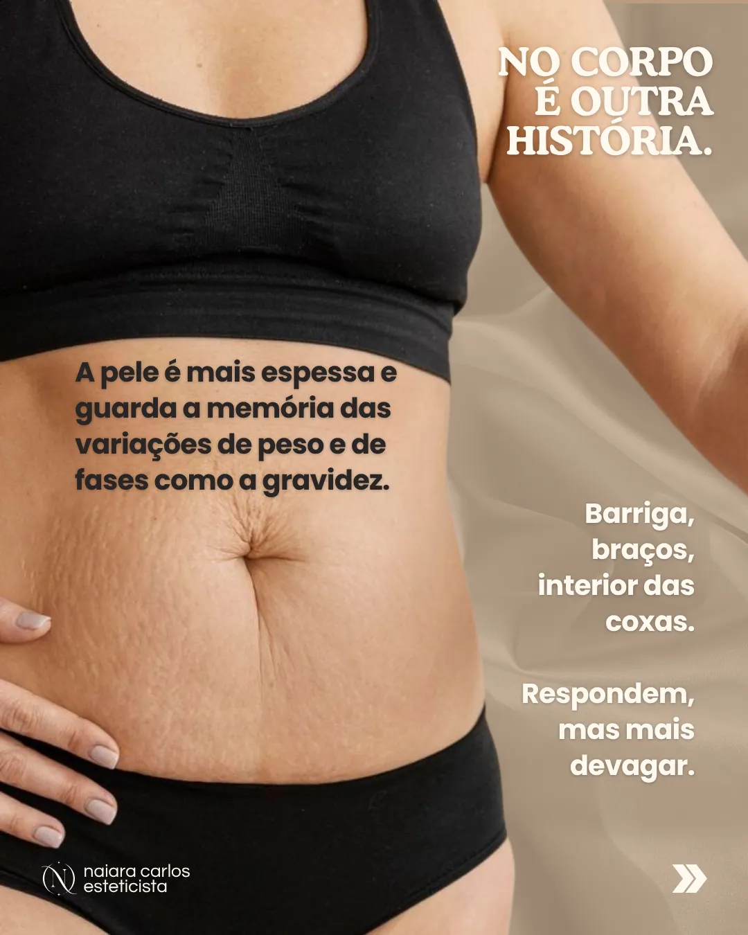 Abdómen com marcas de gravidez: no corpo a pele é mais espessa e guarda a memória das variações de peso, na barriga, nos braços e no interior das coxas, e responde mais devagar