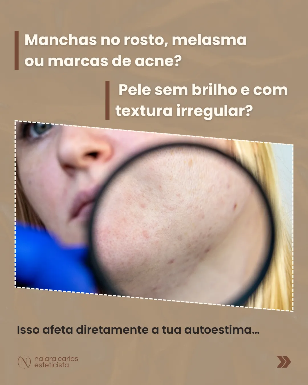 Textura da pele vista em detalhe: manchas no rosto, melasma ou marcas de acne, e pele sem brilho e com textura irregular