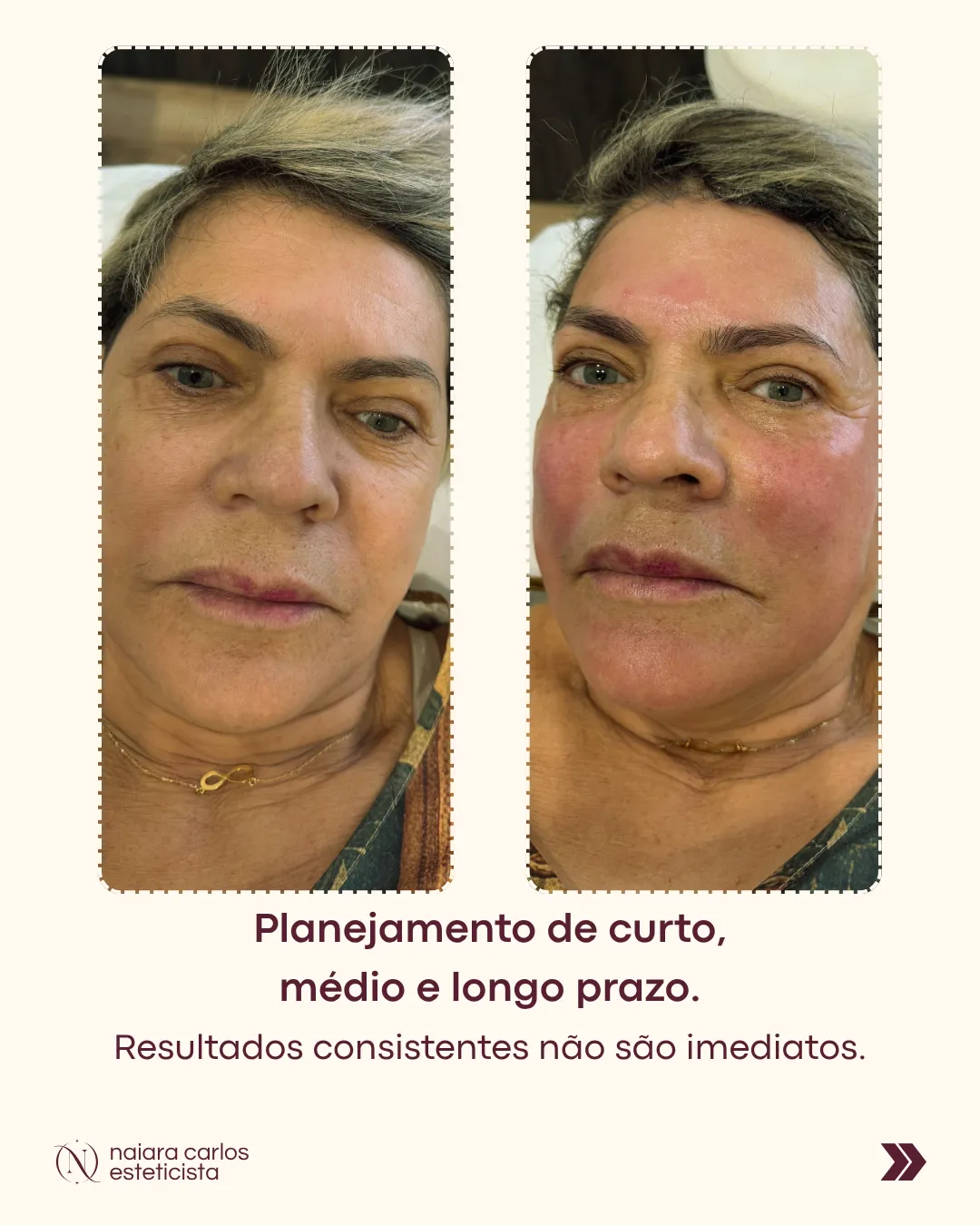 Antes e depois de uma cliente com um plano faseado a curto, médio e longo prazo: resultados consistentes não são imediatos