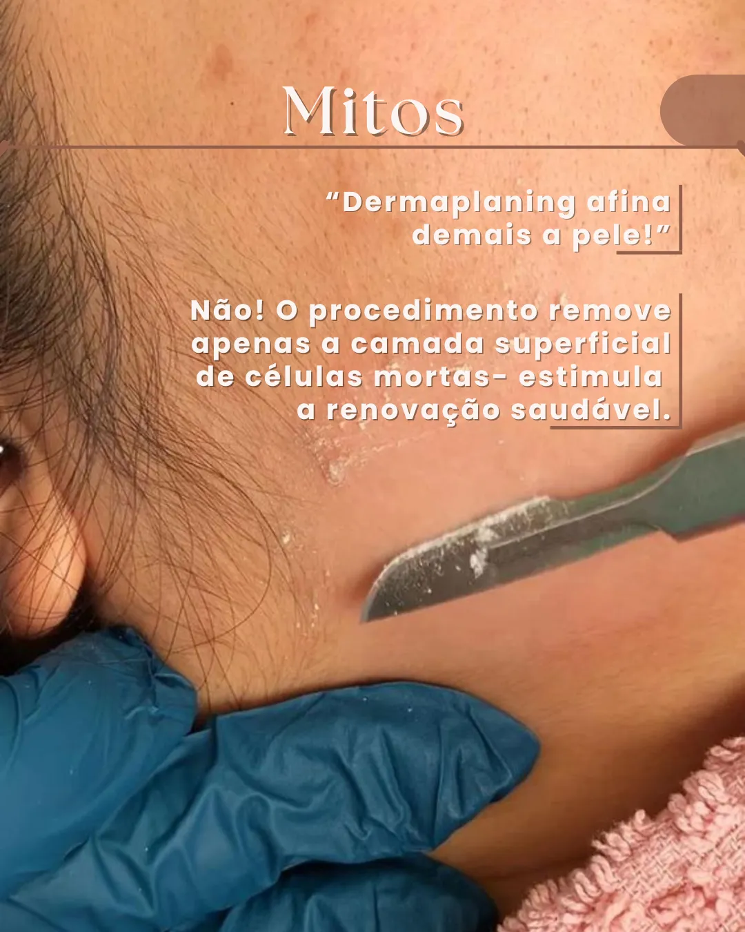 Mito: o dermaplaning não afina a pele, remove apenas a camada superficial de células mortas