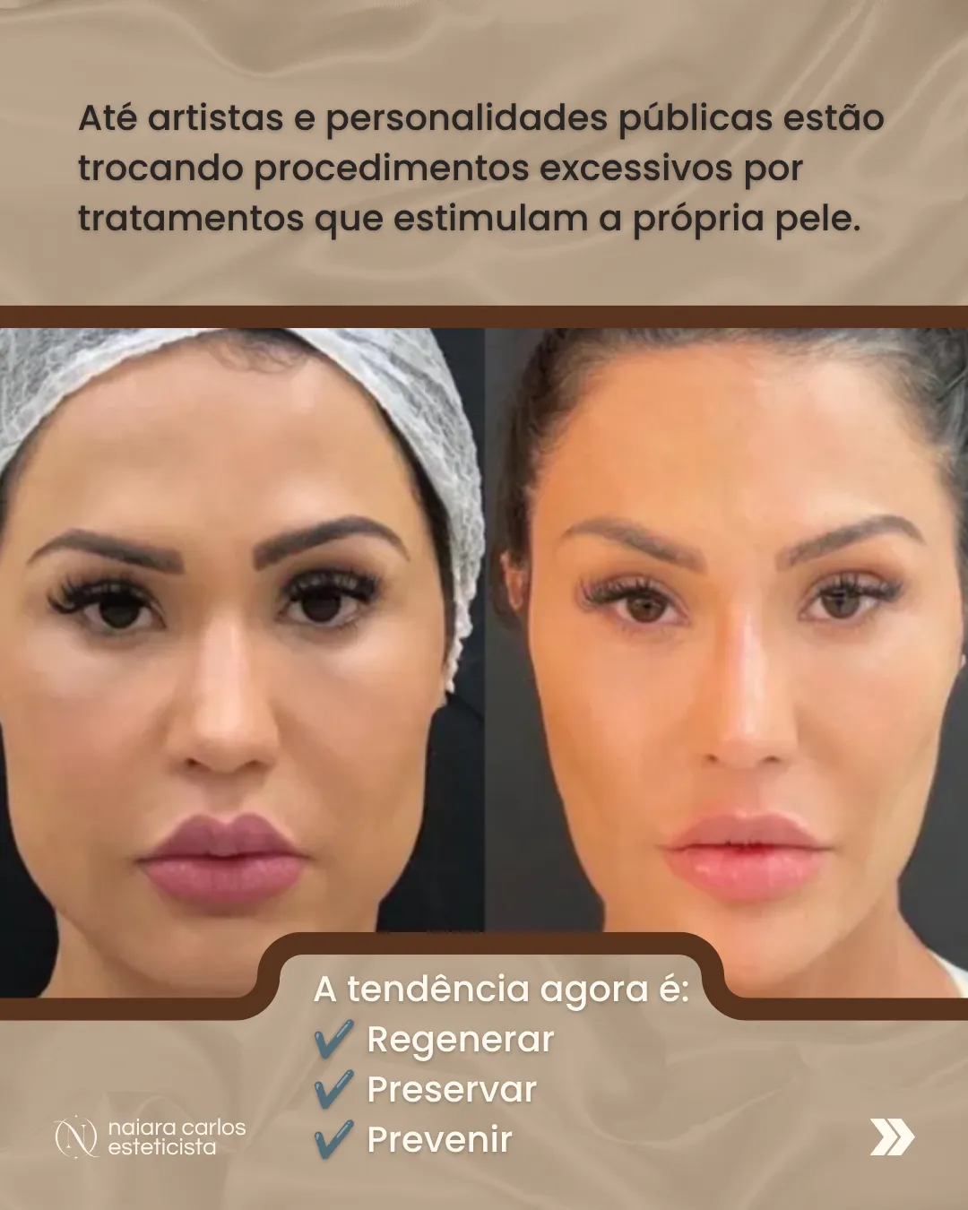 Até artistas e personalidades públicas estão a trocar procedimentos excessivos por tratamentos que estimulam a própria pele: a tendência é regenerar, preservar e prevenir