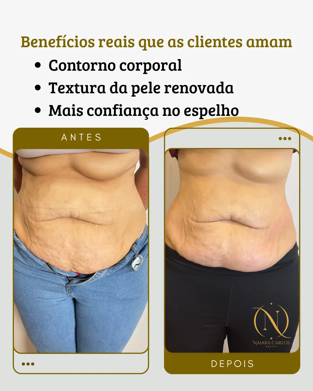 Abdómen de uma cliente antes e depois de um plano com radiofrequência corporal: contorno corporal, textura da pele renovada e mais confiança no espelho